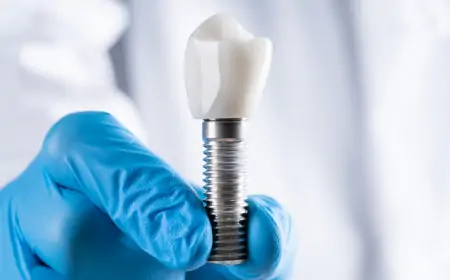 Dental İmplant Nedir, Nasıl Yapılır, Tedavi Süreci Nasıldır?
