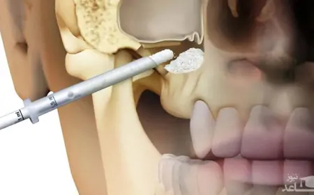 Sinüs Lifting: İmplant Tedavisi İçin Kemik Miktarını Artırma Yöntemi