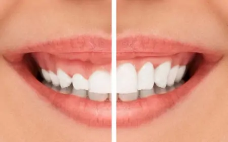 Diş Eti Estetiği: Pembe Estetik ve Avantajları