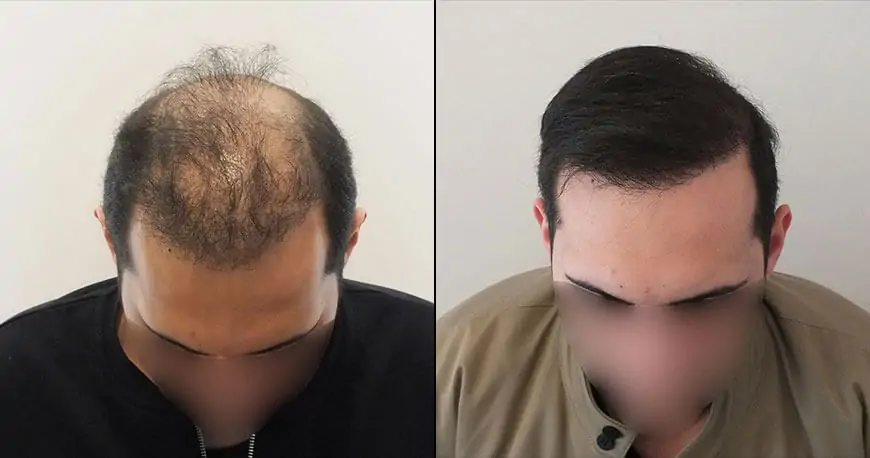 FUT (Follicular Unit Transplantation) Yöntemi: Saç Ekimi İçin Klasik ve Etkili Bir Çözüm