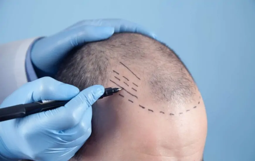 FUE (Follicular Unit Extraction) Yöntemi: Modern Saç Ekimi Tekniği