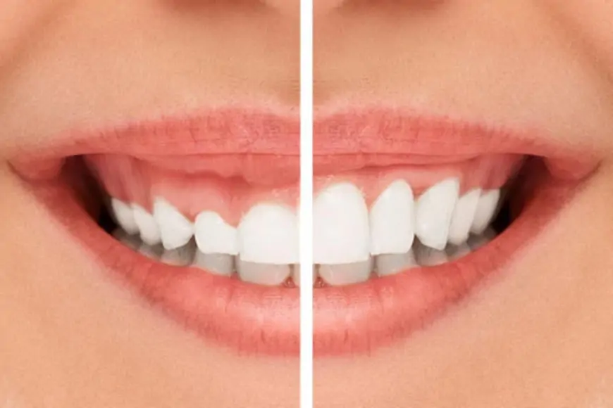 Diş Eti Estetiği: Pembe Estetik ve Avantajları