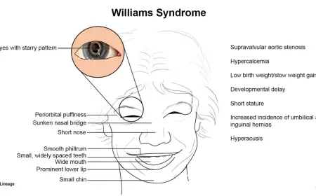 Williams Sendromu Nedir? Belirtileri, Nedenleri ve Tedavi Süreci
