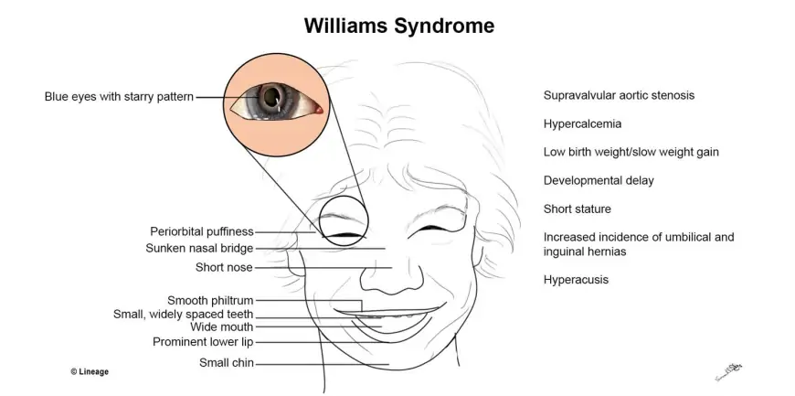 Williams Sendromu Nedir? Belirtileri, Nedenleri ve Tedavi Süreci